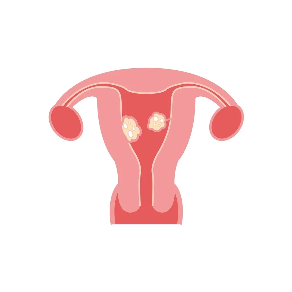 Myom Ursachen, Symptome & Ratgeber für Frauen